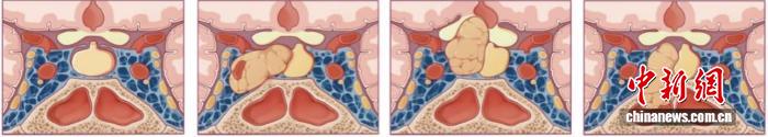助力垂体腺瘤评估识别 中国团队