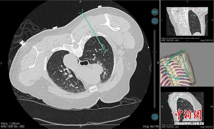 AI机器人精准“导航” 广西一医院实现肺结节消融“一针到位”