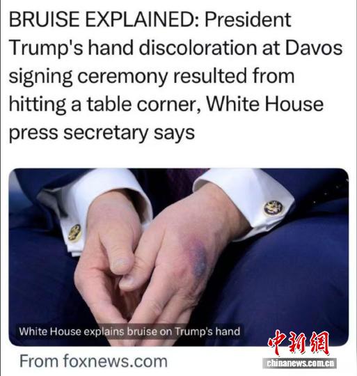 特朗普手背又现“淤青”？这次据说与“和平委员会”相关……